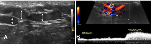 varicocele